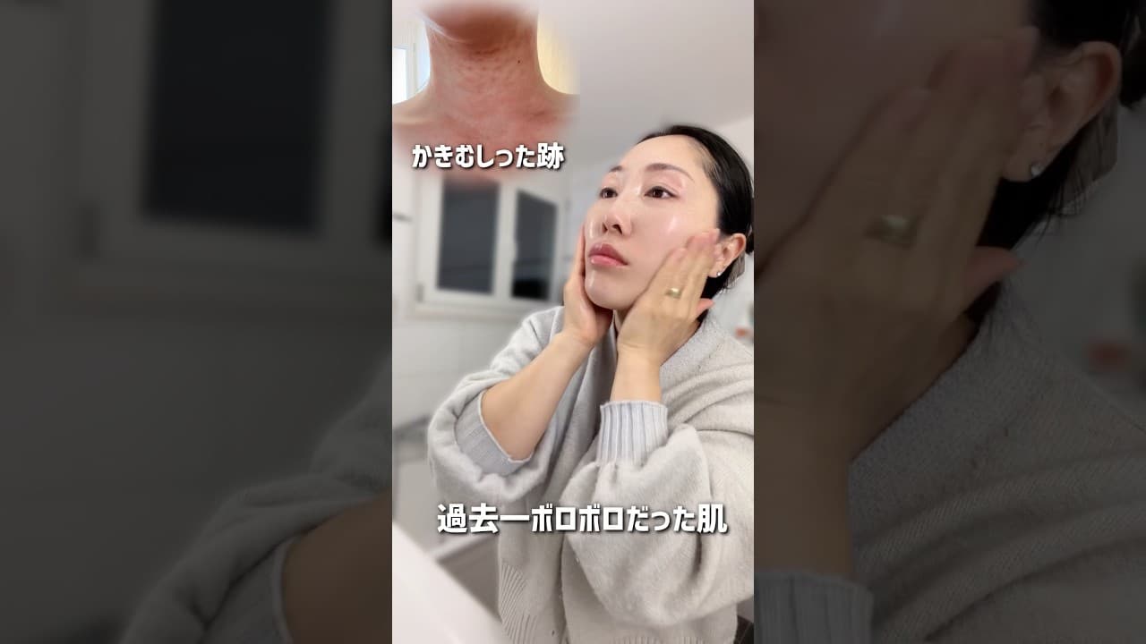 海外スイス在住アラフォー4児ママ|今だから見せれる、最悪だった時の肌#shorts